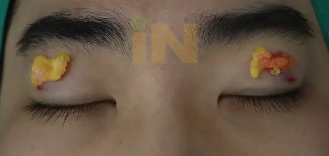 작은 구멍을 통해 완전히 제거된 지방
