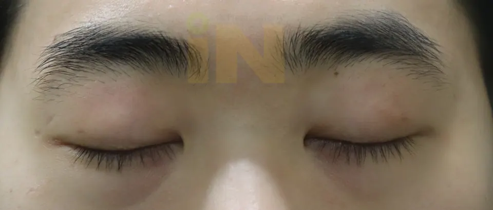눈두덩이지방제거 수술후