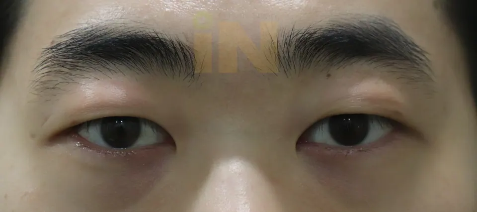 눈두덩이지방제거 수술후