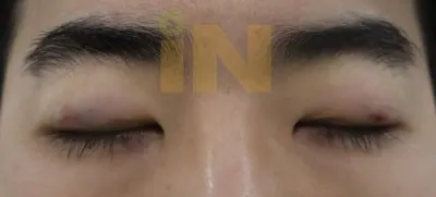 눈두덩이지방제거 수술직후 부기와 멍
