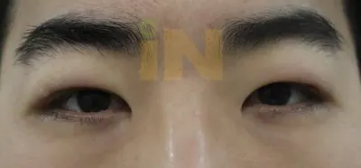 눈두덩이지방제거 수술직후 부기와 멍