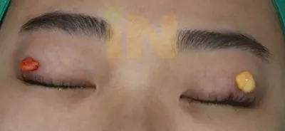 눈두덩이지방제거 수술중