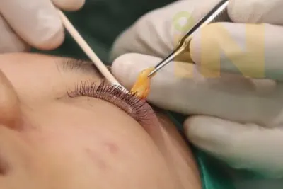 눈두덩이지방제거 수술중 제거되는 지방