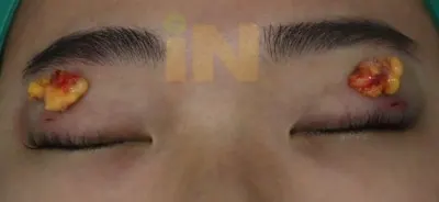 눈두덩이지방제거 수술중 작은 구멍을 통해 완전히 제거된 지방