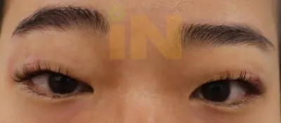 눈두덩이지방제거 수술직후 부기와 멍