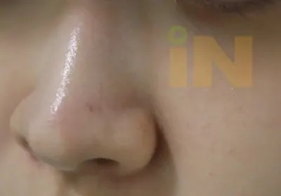 코점제거 수술후 4개월 경과