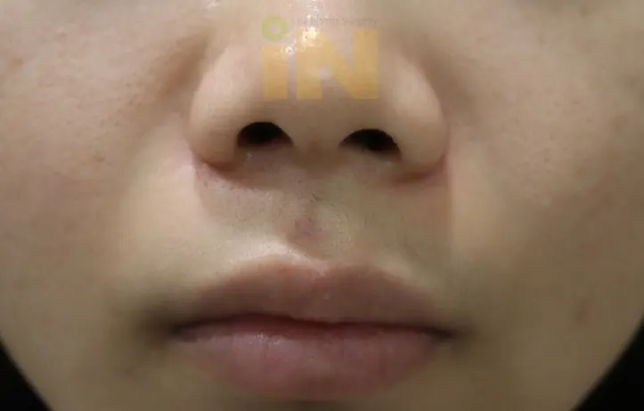 인중 점제거 수술후 2개월