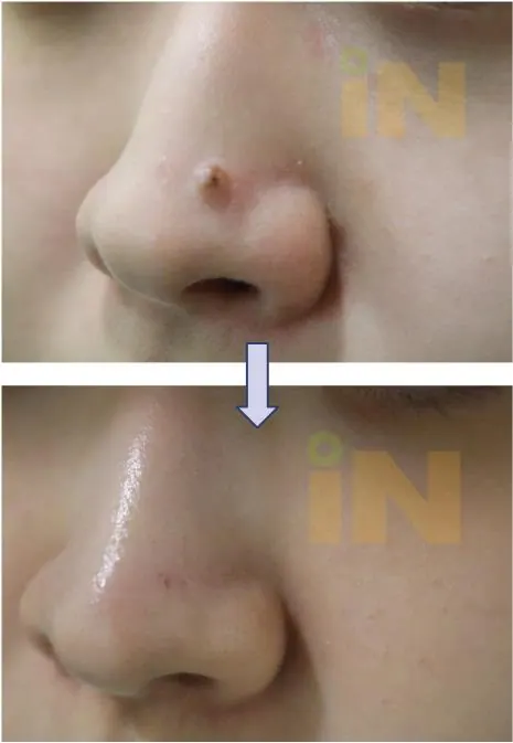 점뺀흉터 제거 전후