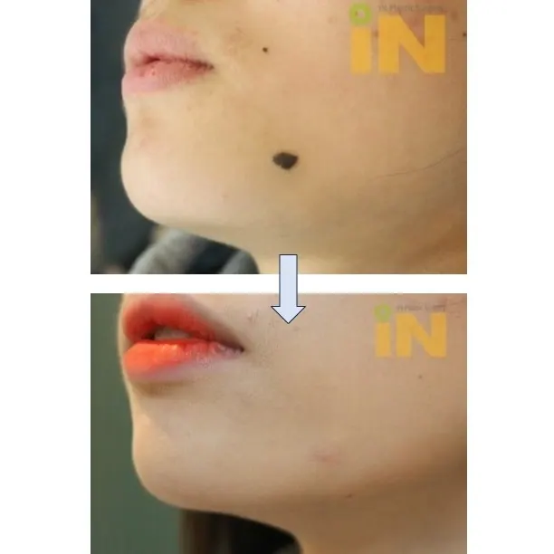 턱 옆 검은 점제거 전후, 측면