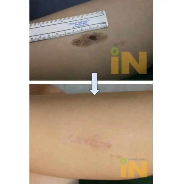 팔 넓은 선천성 모반 제거 전후, 자로 크기 측정