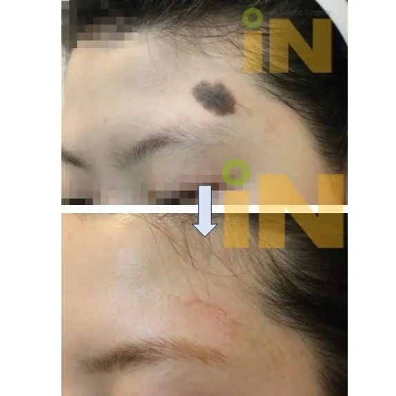 눈썹 위 이마 선천성 모반 제거 전후