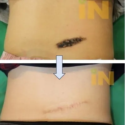 배 부위 긴 선천성 모반 제거 전후