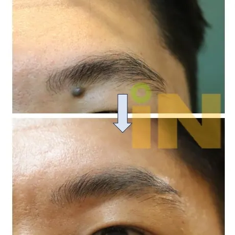 눈썹 아래 볼록한 점제거 전후