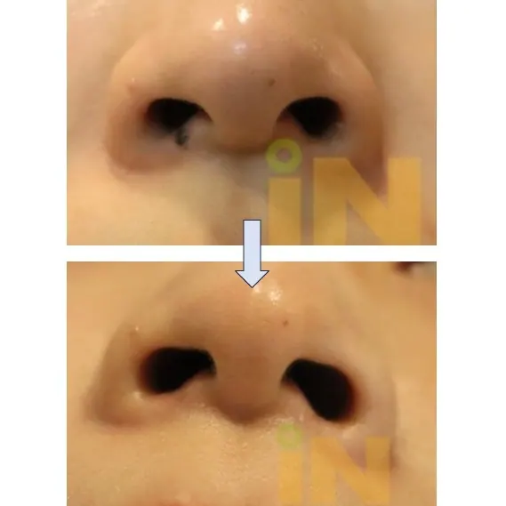 콧구멍 안쪽 점제거 전후