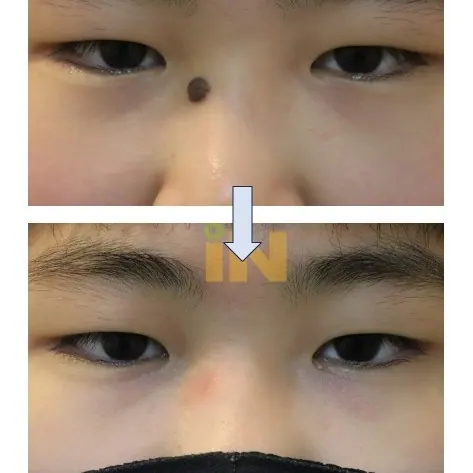 콧대 시작 부위 점제거 전후, 정면