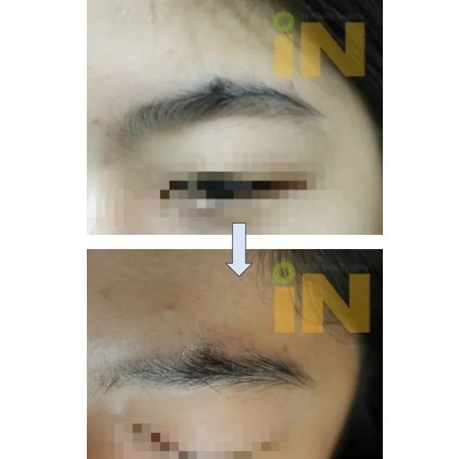 눈썹 부위 점제거 전후, 비스듬한 각도